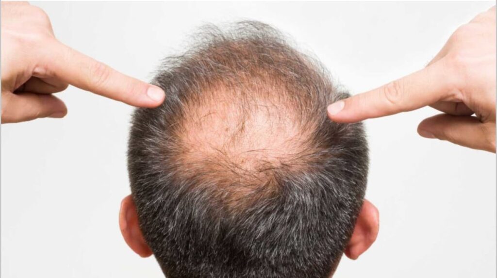 Man examining hair thinning area on his scalp, fingers pointing to balding spot