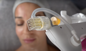 A professional mesotherapy treatment using the Korean Crystal Meso injector to deliver PRP and skin booster serums deep into the skin for smooth and glowing texture at Glow Matrix.