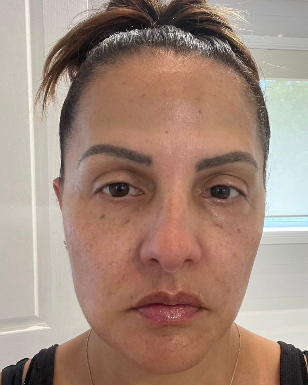 Results PRP with Microneedling, skin booster for Skin Tightening
