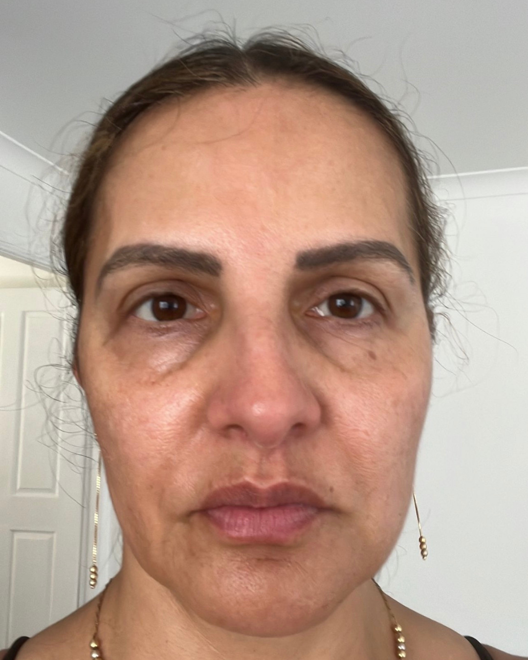 PRP & Skin booster before after results Sydney - dehydrated skin transformed to radiant glow
