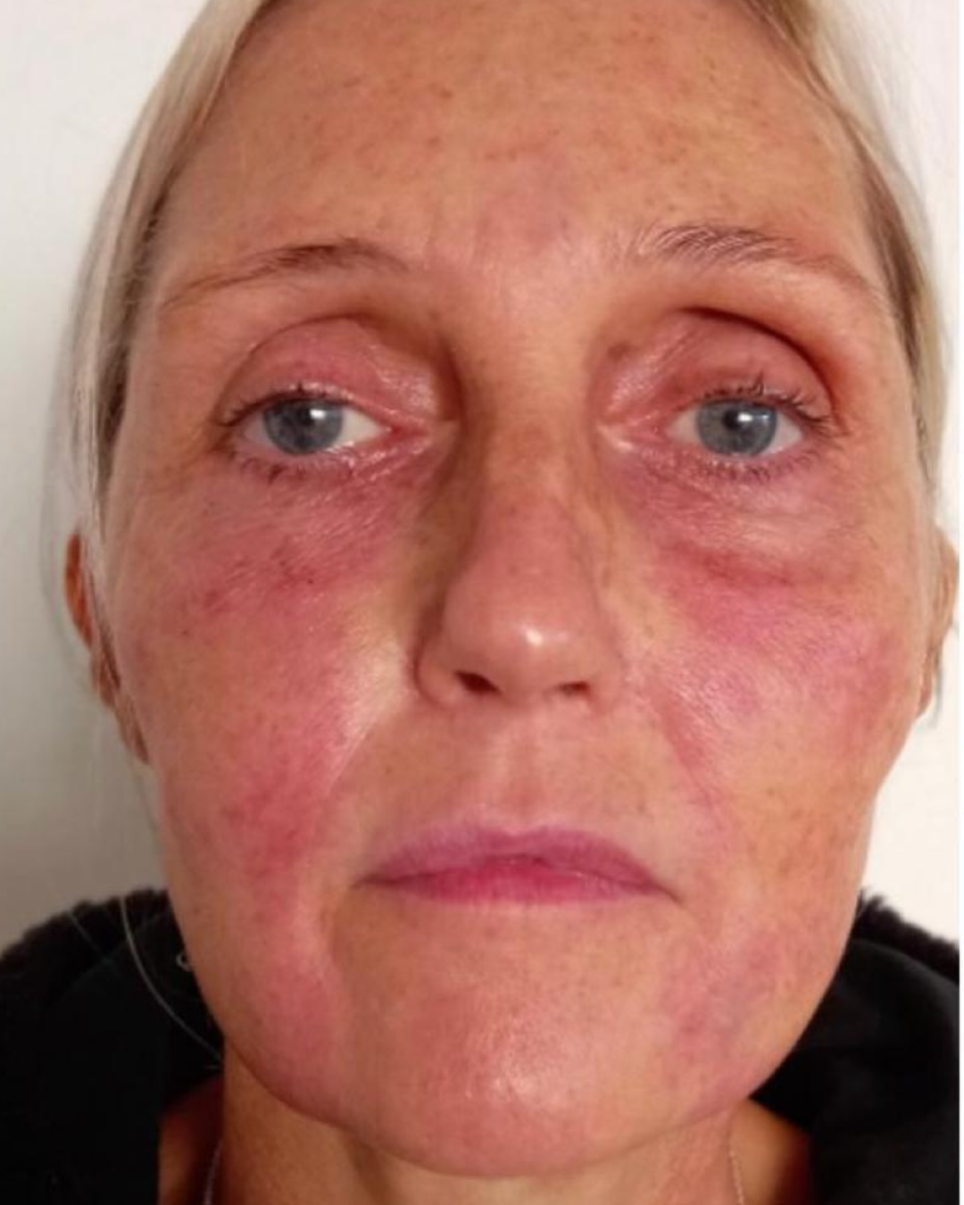 PRP delivered with meso-injector & salmon DNA after photo Sydney - Skin tightening/collagen induction therapy