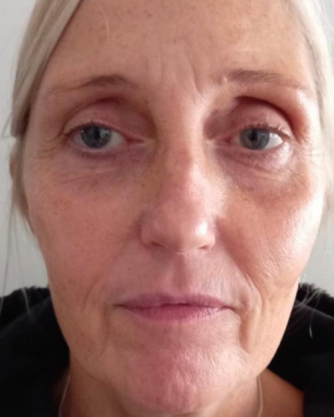 PRP meso-injector with salmon DNA before photo Sydney - aging skin concerns