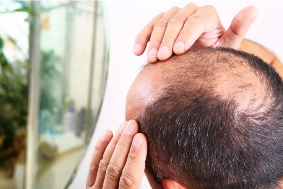 Middle-aged man with hand on his head, feeling the texture and density of his hair, confronting the reality of hair loss
